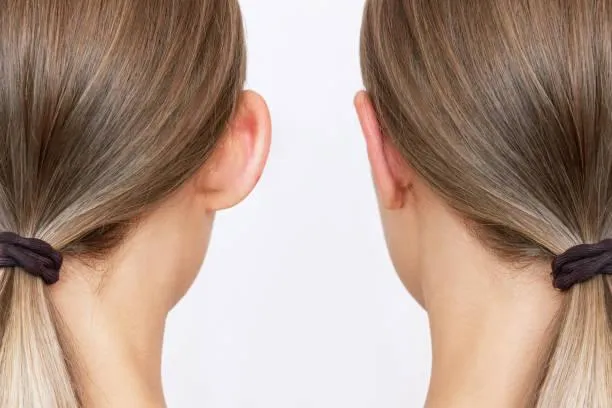 Imagem ilustrativa de Cirurgia de otoplastia em fortaleza