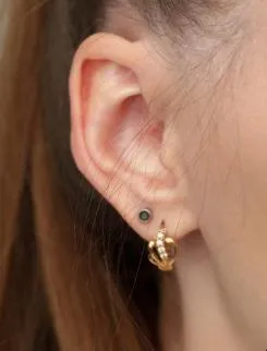 Imagem ilustrativa de Reparação de lóbulo orelha