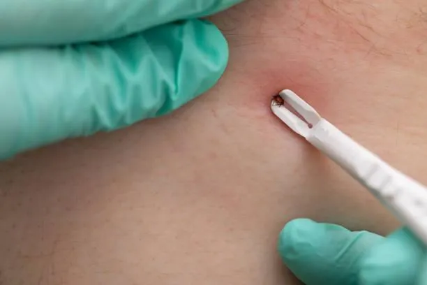 Imagem ilustrativa de Retirada de sinais